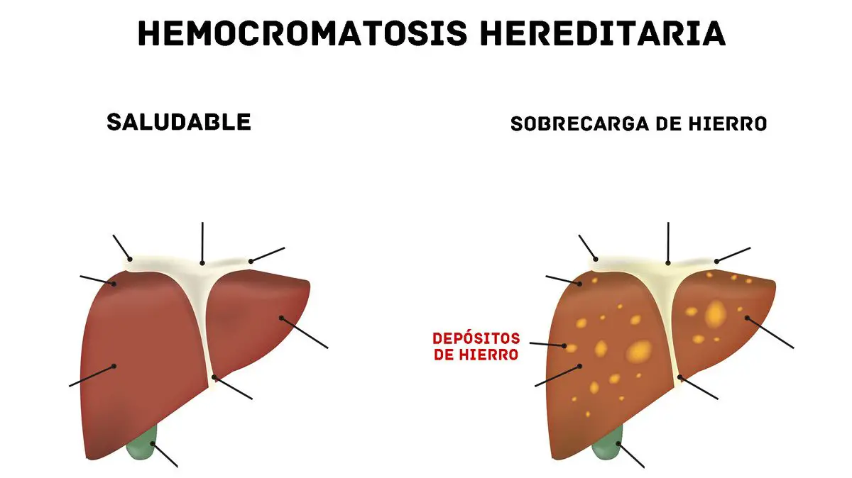 Sobrecarga