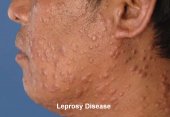 leprosy